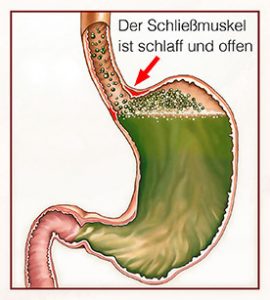 Grafik eines Magens mit geöffnetem Schließmuskel