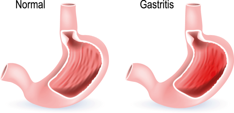 Wie Lange Dauert Eine Gastritis www.sodbrennen-helfer.de