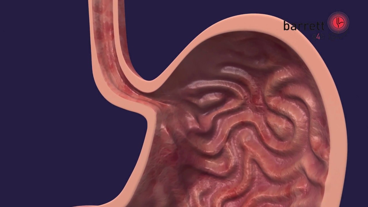 BarrettSyndrom Was ist die Ursache? 【ᐅᐅ】Erfahren Sie mehr.